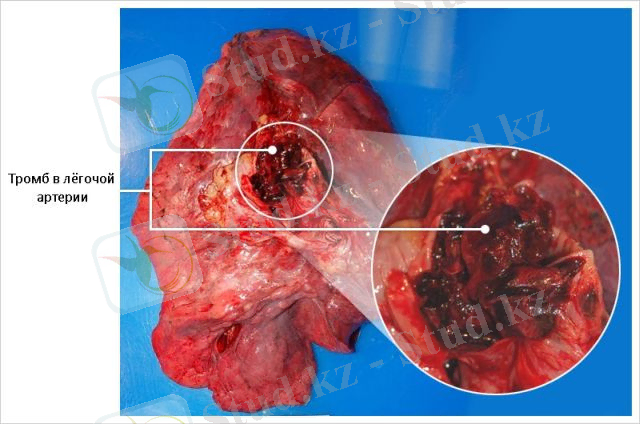 https://smithhealthcentre.com/wp-content/img/tromboemboliya-legochnoj-arterii-okazanie-pervoj-pomoshi-i-lechenie-tela-2.jpg