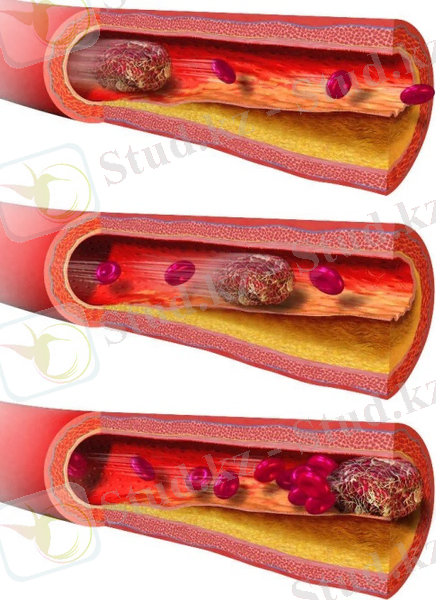 C:\Users\Жусипбек Калдыбай\Desktop\limb-embolism-and-ischaemia.jpg