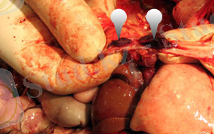 тромб в аорте у кота