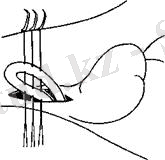 Рис. 143. Сшивание полового члена в сигмовидном изгибе (по В. С. Шитілову)
