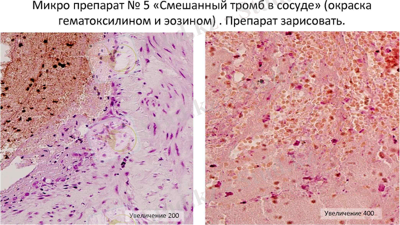 Микро препарат № 5 «Смешанный тромб в сосуде» (окраска гематоксилином и эозином). Препарат зарисовать.