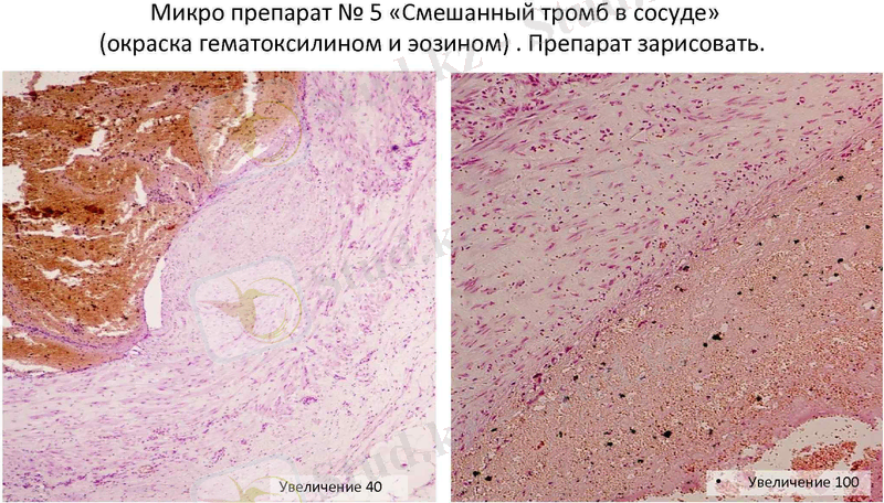Микро препарат № 5 «Смешанный тромб в сосуде» (окраска гематоксилином и эозином). Препарат зарисовать.