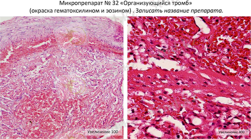Микропрепарат № 32 «Организующийся тромб» (окраска гематоксилином и эозином). Записать название препарата. Увеличение 100