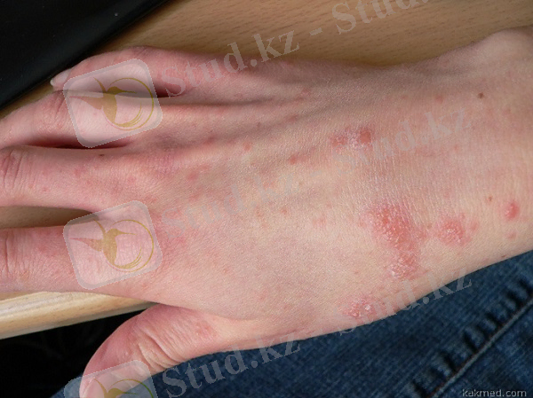 чесотка-на-руках