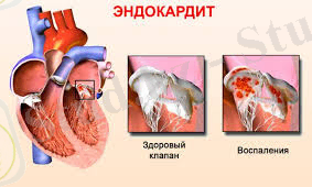 Боль в сердце у собаки. Врожденные и приобретенные пороки сердца у собак: когда есть шансы спасти любимца? Причины развития хронической сердечной недостаточности у собак