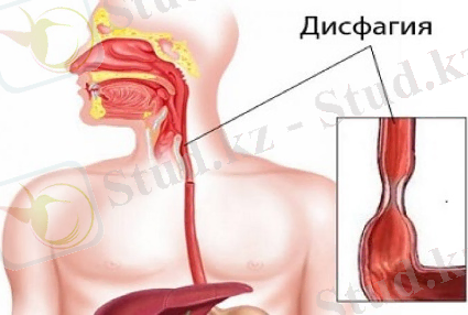 Картинки по запросу "дисфагия деген не""