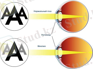 Миопия (близорукость) | Аллегро