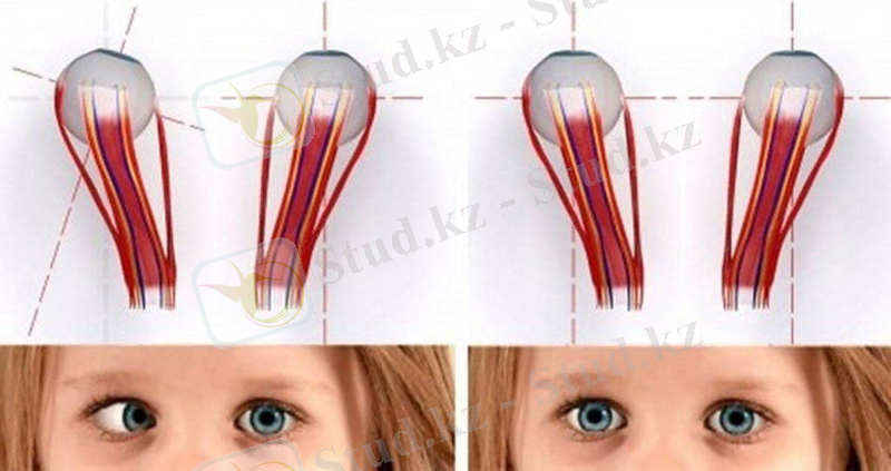 Косоглазие (страбизм) - причины, симптомы | Профилактика и упражнения для лечения косоглазия