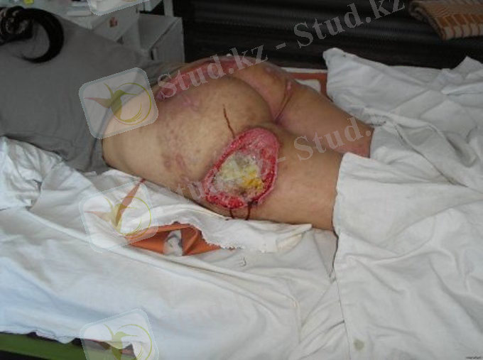 Хирургическое отделение Сакского ТМУ лечение пролежней - Лечение пролежней области крестца