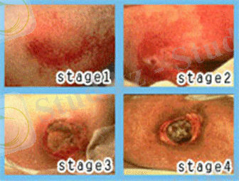 What does Pressure Ulcers look like. Are you also searching for Pressure Ulcers clinical trials?
