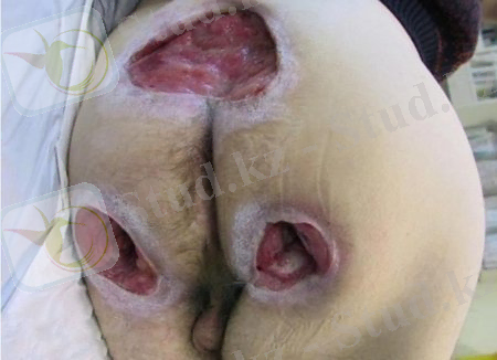 Пролежни больных. Фото просто полная жесть " ТутСмеха.Нет-сайт жести, жесть онлайн, фото мёртвых