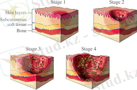 противопролежневый матрас противопролежневый матрац купить противопролежневый матрас для лежачих больных лечение пролежней