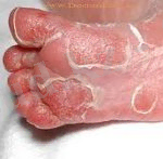  Туа біткен мерез 