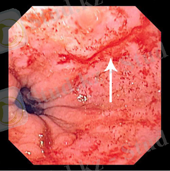 D:\Нурхан 4-курс\mallory_weiss_tear_high_ru.jpg