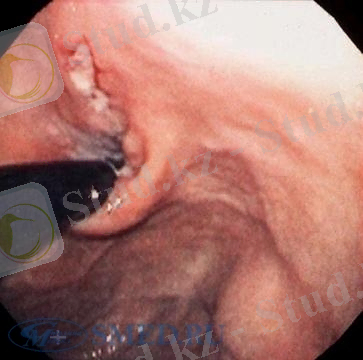 D:\Нурхан 4-курс\Mallory-Weiss endo 2.jpg