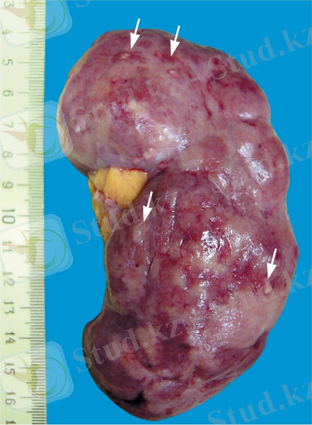 http://vmede.org/sait/content/Anatomija_patologicheskaja_3airatyan_2010/8_files/mb4_015.jpeg
