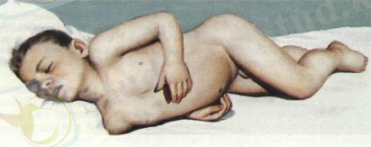 поза больного с запущенным менингитом