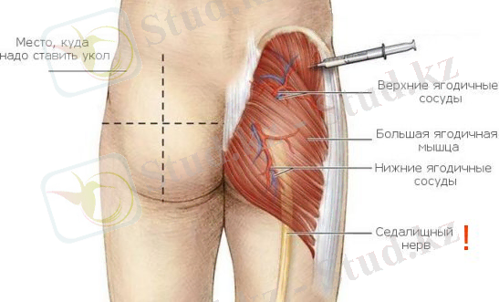 Внутримышечные инъекции