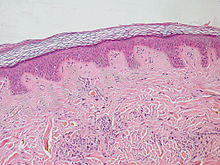 https://upload.wikimedia.org/wikipedia/commons/thumb/b/b4/Normal_Epidermis_and_Dermis_with_Intradermal_Nevus_10x.JPG/220px-Normal_Epidermis_and_Dermis_with_Intradermal_Nevus_10x.JPG