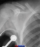 бұғана сынуы