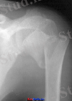 Иық сүйек сынуы