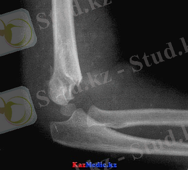 Айдаршық сынуы