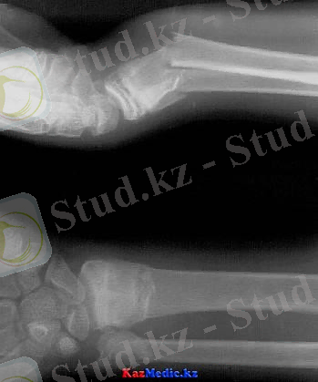 Білек сынығы