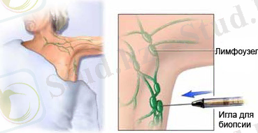 D:\Desktop\сс\biopsiya-podmyshechnogo-limfouzla.jpg