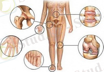 D:\Desktop\Новая папка\1444648262_tuberkulez-kostey-i-sustavov.jpg