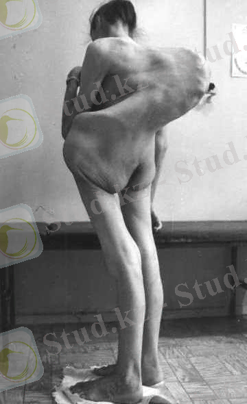 D:\Desktop\Новая папка\tuberkulez-kosti04.jpg