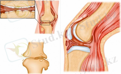 D:\Desktop\Новая папка\Tuberkulez-kostej-i-sustavov1.jpg