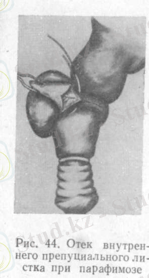 парафимозбен ішкі қабаттың ісінуі