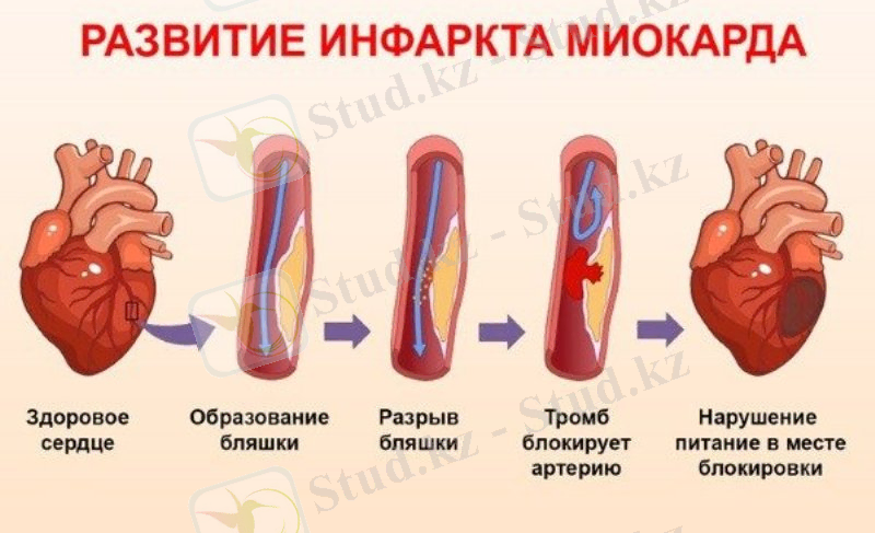 Инфаркт миокарда – грозное осложнение сердечно-сосудистых заболеваний — Семейная Клиника