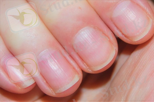 Hiányzik a kis félhold a körmödről? 10 elváltozás, ami betegséget jelezhet - Egészség | Femina