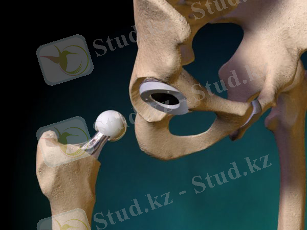 Феморальды мойынды қалпына келтіру емінің сынуы. Жарақаттың салдары және алдын-алу. Жамбастың сынуы кезіндегі хирургиялық емдеу