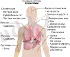 https://upload.wikimedia.org/wikipedia/commons/thumb/e/e9/Symptoms_of_leukemia_ru.png/150px-Symptoms_of_leukemia_ru.png