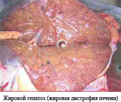 girovoi%20gepatoz