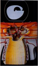 Диск зрительного нерва в развитой стадии глаукомы