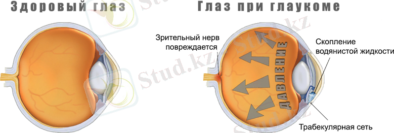 glaucoma-eye-pressure