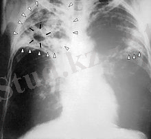 Tuberculosis-x-ray-1.jpg