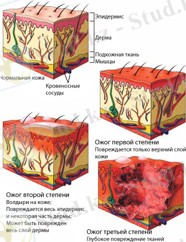 http://omedicine.info/wp-content/uploads/2012/12/classification-of-skin-burns.jpg