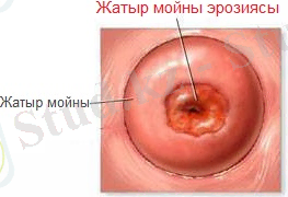 Жатыр мойны эрозиясы, Жатыр мойны эрозиясы, Жатыр мойны эрозиясы суреті, эрозия шейки матки