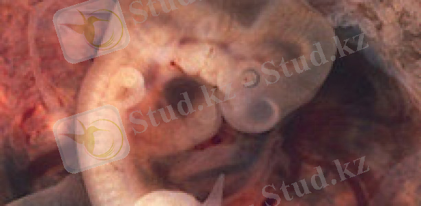 Жетілмей қалған жүктілік