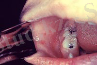 Koplik spots, measles 6111 lores.jpg