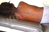 Measles in African Child 3.JPG