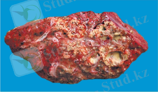 Картинки по запросу казеозный некроз лимфоузла при туберкулезе