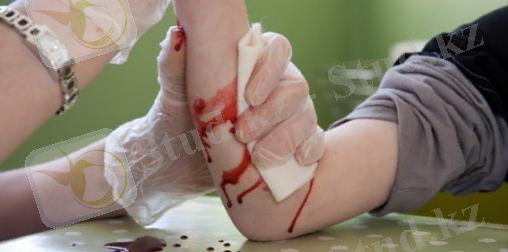 оказание первой помощи при кровотечениях