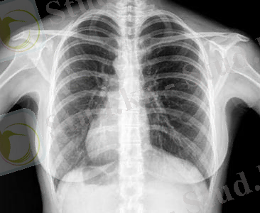 Картинки по запросу флюорография это