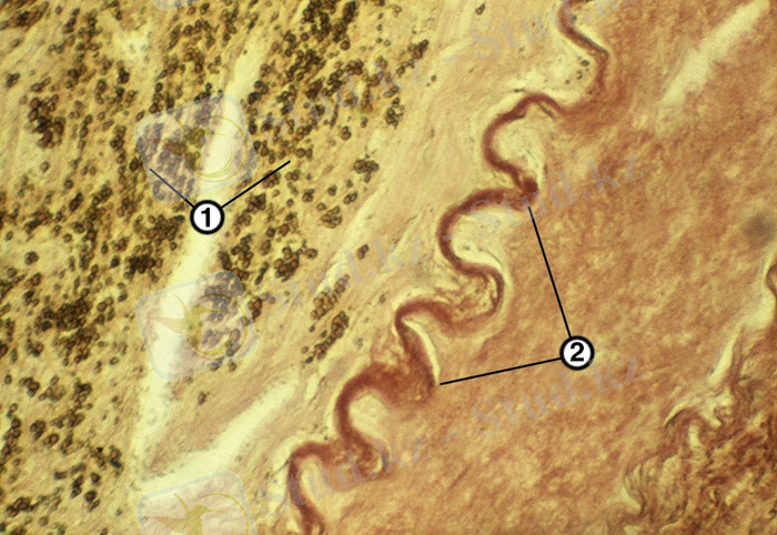 Микропрепарат стенки аорты при атеросклерозе: 1 — массивное отложение солей кальция в атеросклеротическую бляшку; 2 — внутренняя эластическая мембрана. <a href=