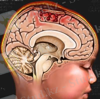 Картинки по запросу умственная отсталость